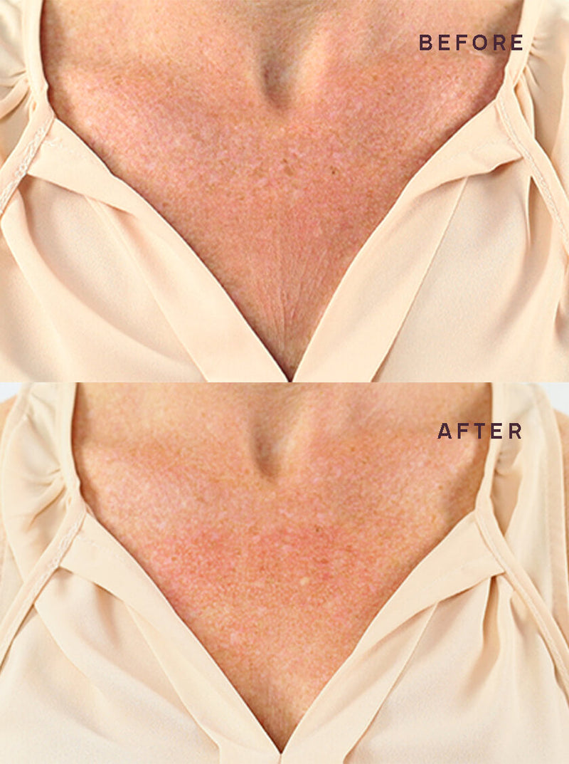 Breast-Wrinkles-Removal-Results