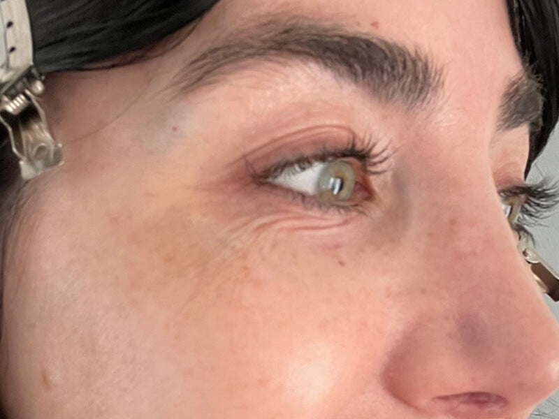 Eye-Wrinkle-Removal-Product-Before