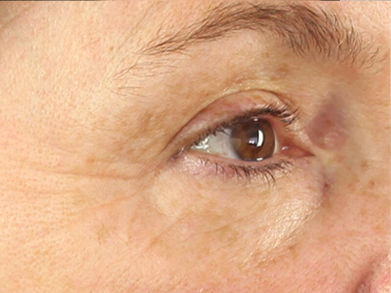 Eye-Wrinkle-Removal-Products-Before