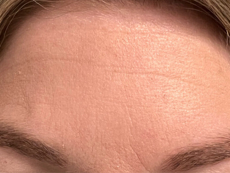 Forehead-Wrinkle-After-Rachael