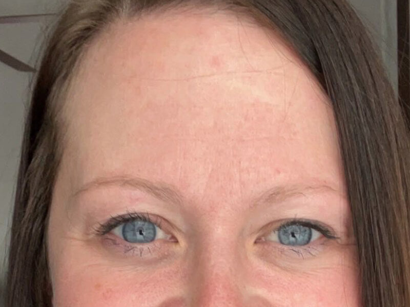 Forehead-Wrinkle-After