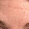 Forehead-Wrinkle-Before-Rachael