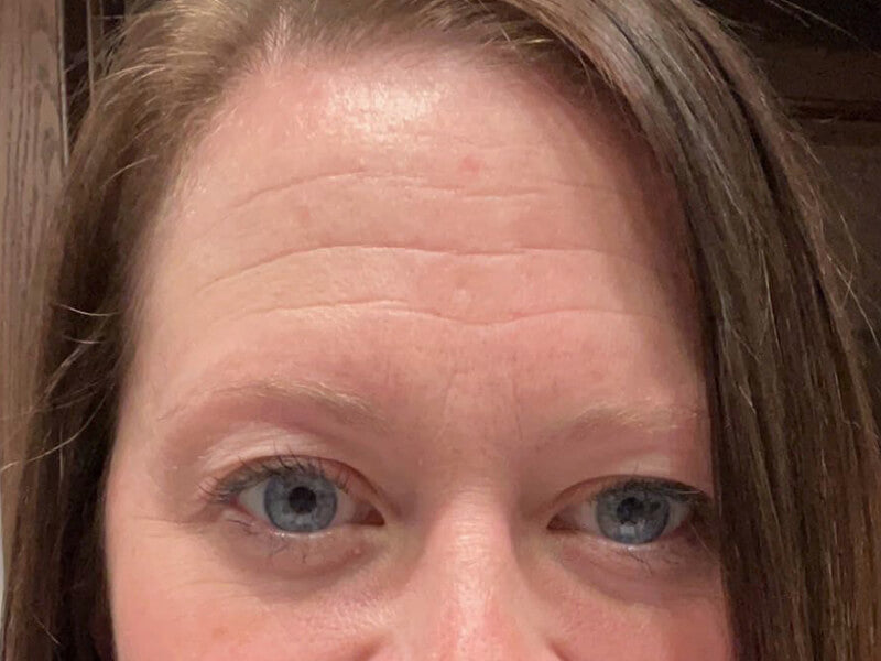 Forehead-Wrinkle-Before