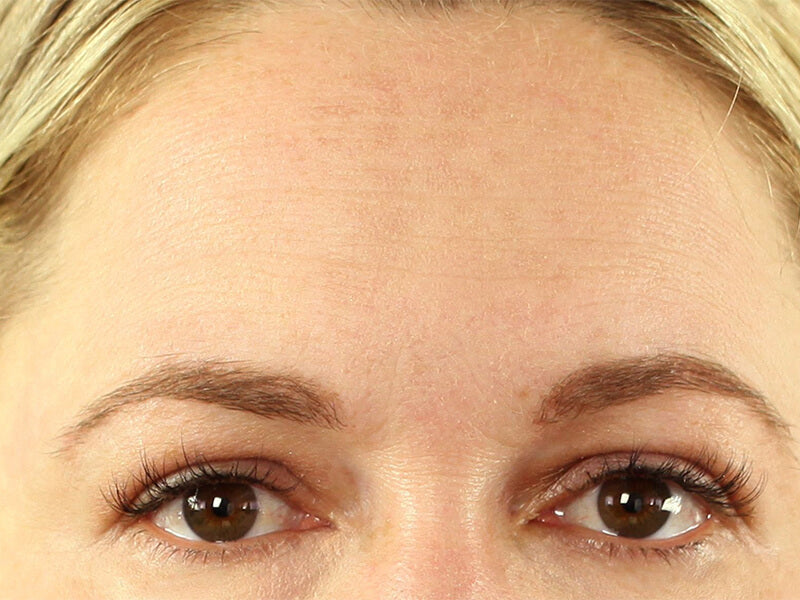 Forehead-Wrinkle-Removal-Product-After