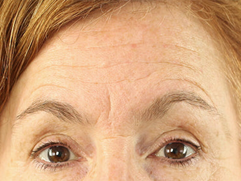 Forehead-Wrinkle-Removal-Products-Before
