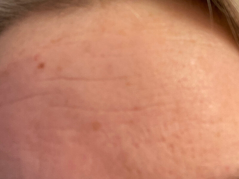 Forehead_Wrinkle_After_Closeup