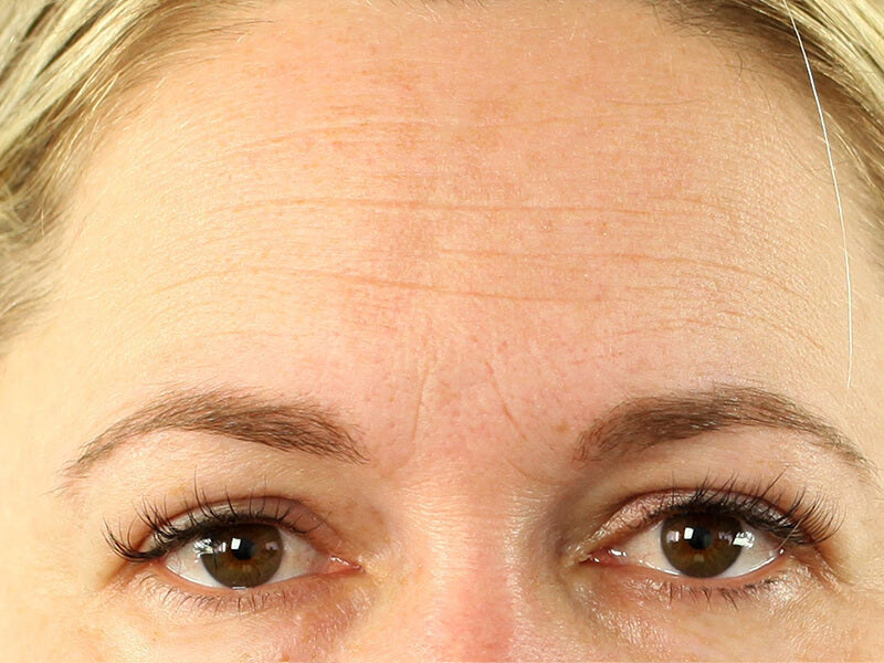 Forehead_Wrinkle_Before