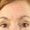 Forehead_Wrinkle_Before_Old
