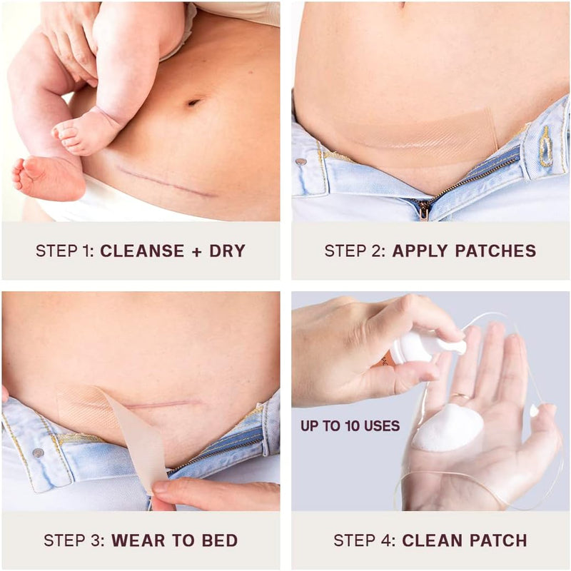 SILICONEFUSION™ C-Section Scar Patch
