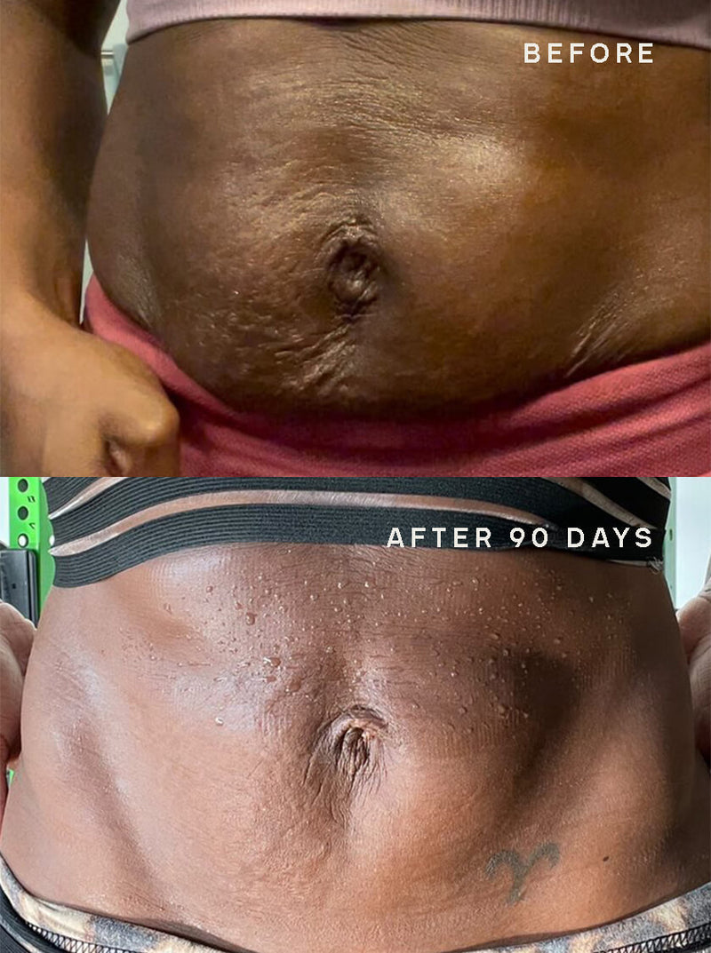 Stretch-Marks-Loose-Skin_Redution-Results